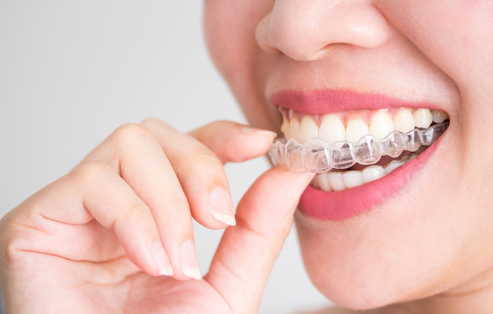 How Invisalign Works: Exploring its Mechanisms and Benefits