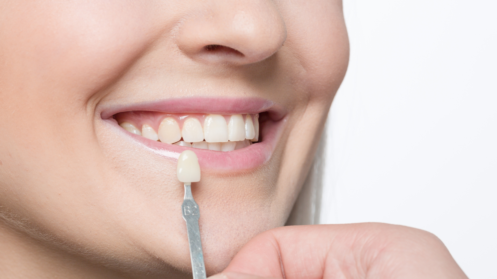 Discover the benefits of porcelain veneers.