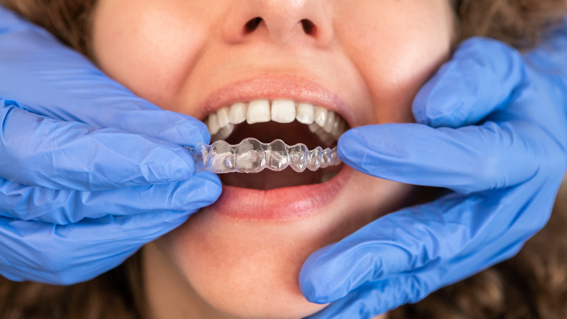 What is Invisalign aligners.