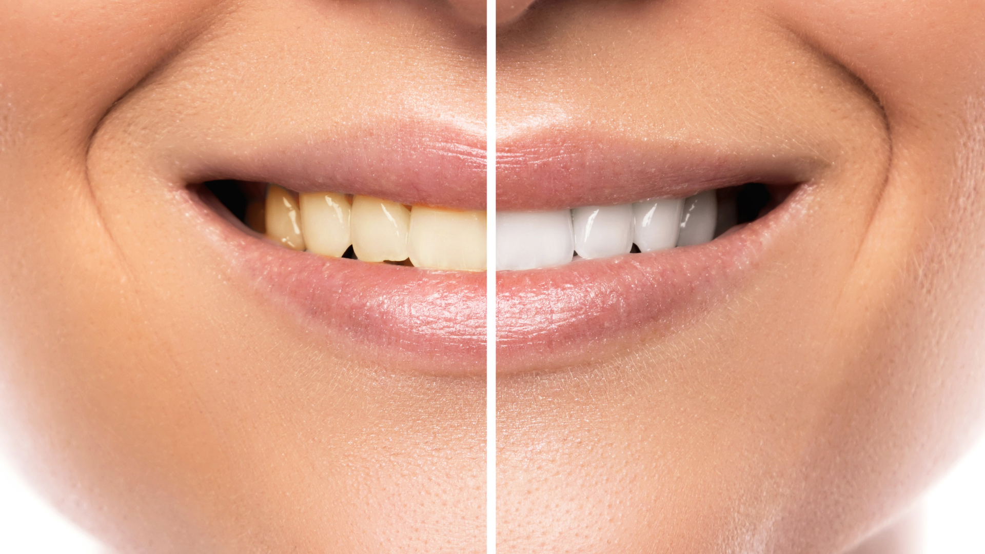 A woman 's teeth before and after whitening.