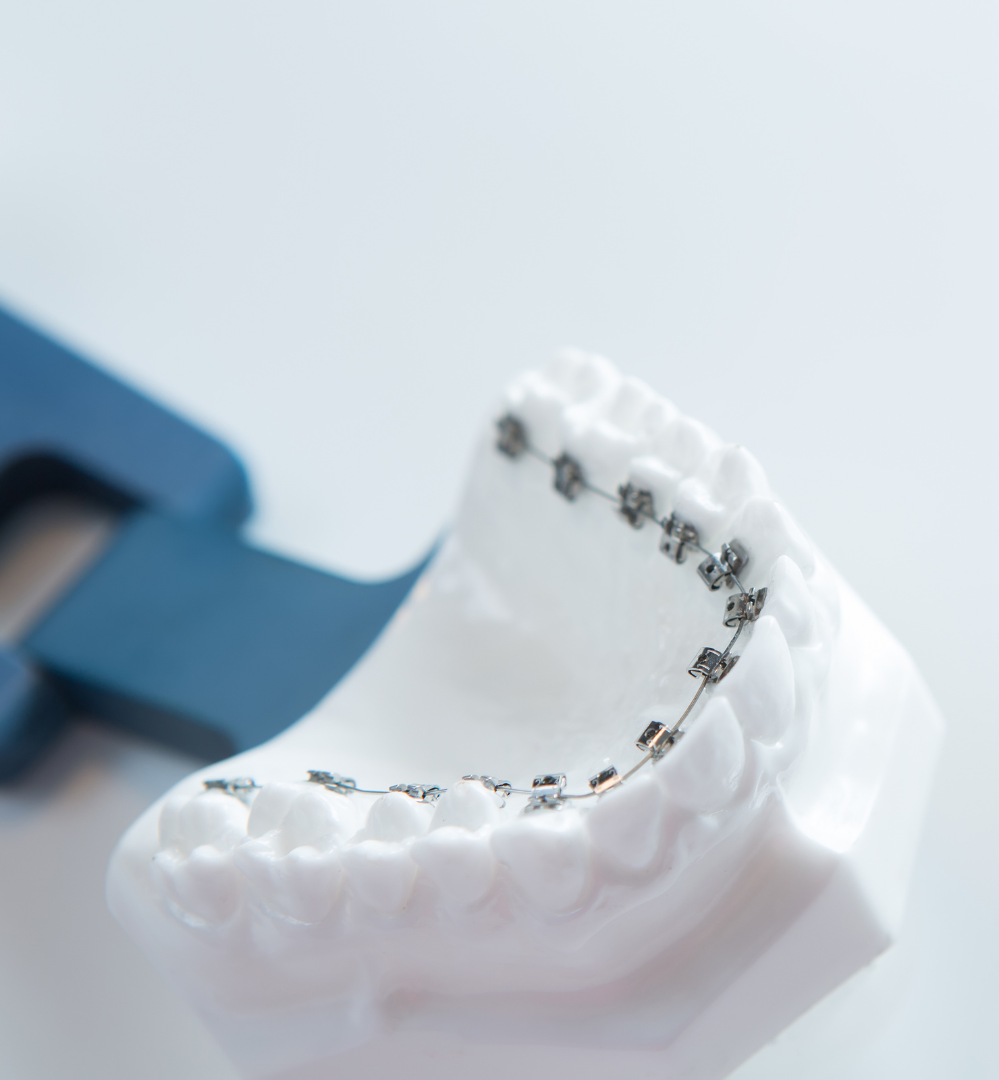 A model of a person 's teeth with braces on them