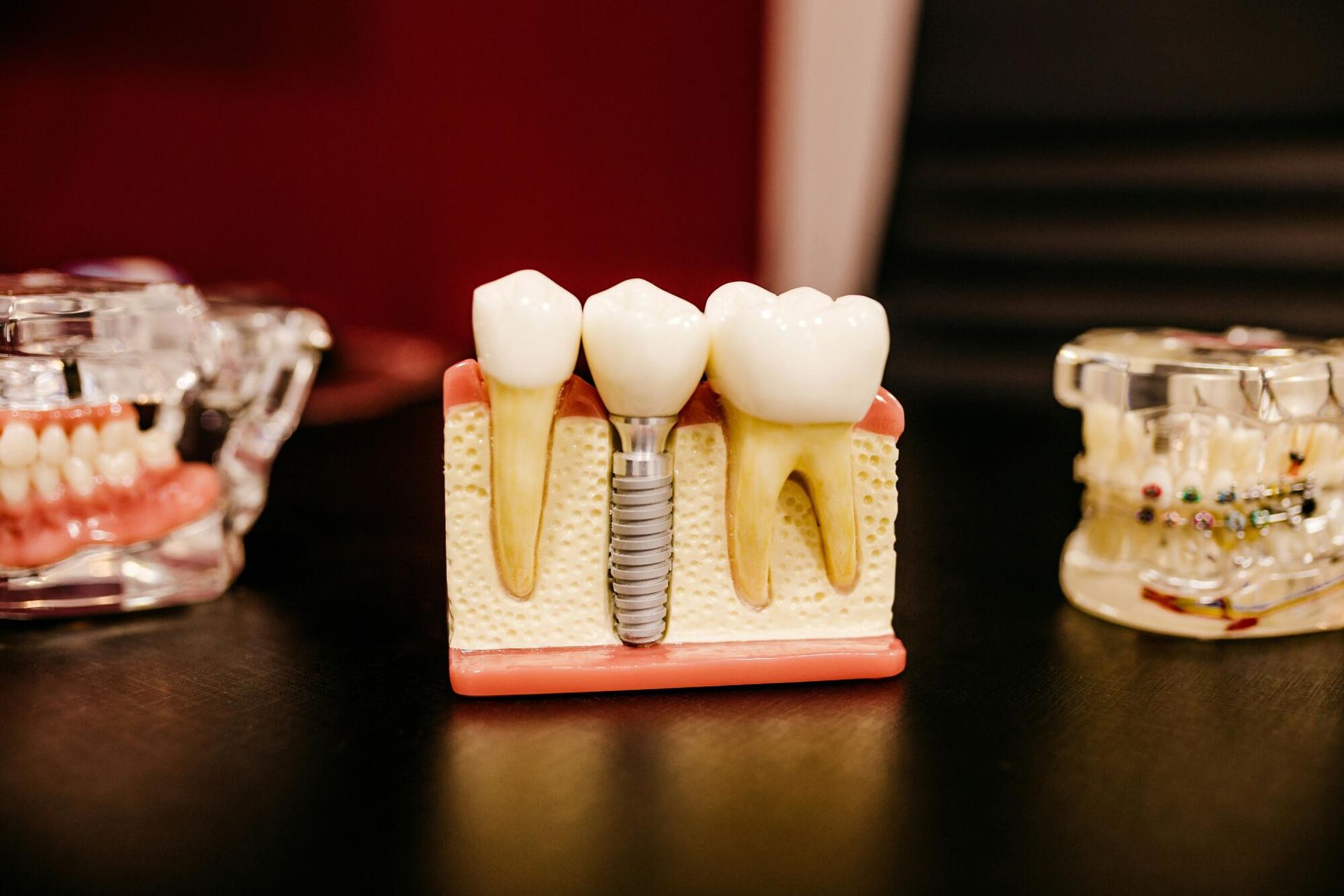Dental implant model showing tooth crowns and screws on a stand, with clear dental models in the background