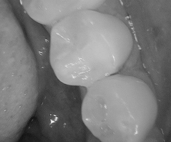 a close up of a person 's teeth in a black and white photo .