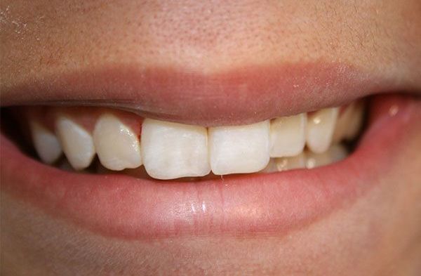 a close up of a person 's mouth with white teeth .