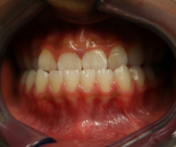 a close up of a person 's teeth with red gums