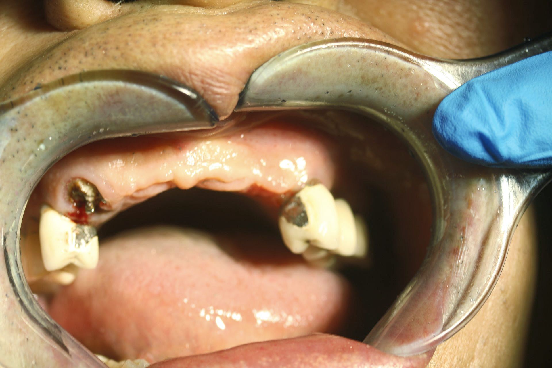 a close up of a person 's mouth with a tooth missing .