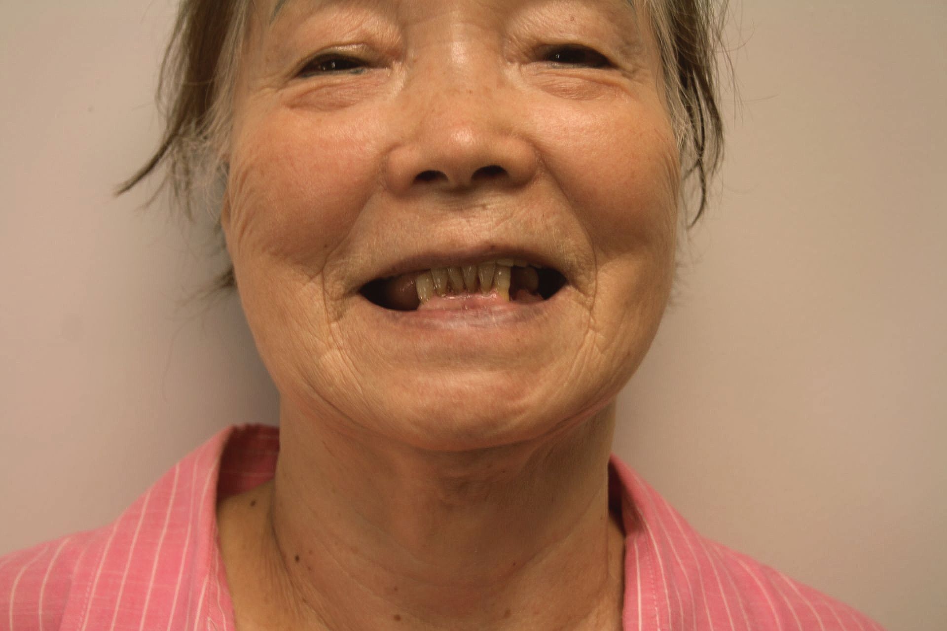 a woman with missing teeth is smiling for the camera .