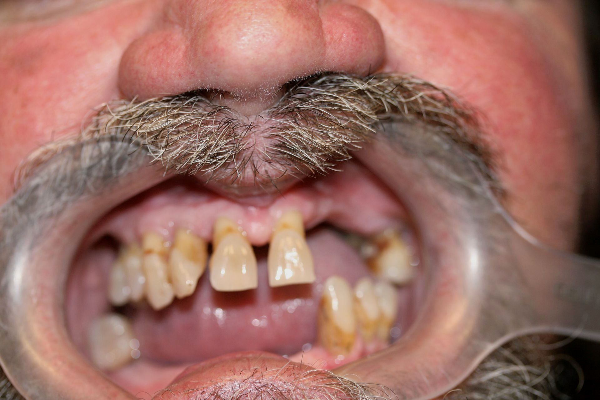 a man with a mustache and missing teeth is wearing a mouth guard .