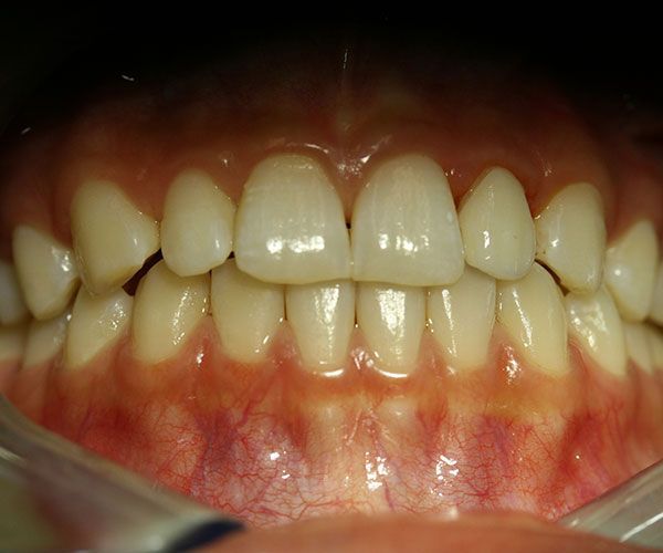 a close up of a person 's teeth and gums .