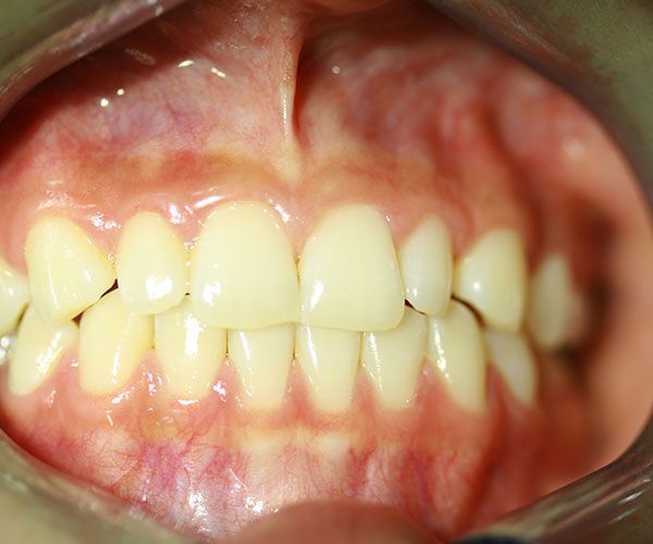 a close up of a person 's mouth with their teeth showing .