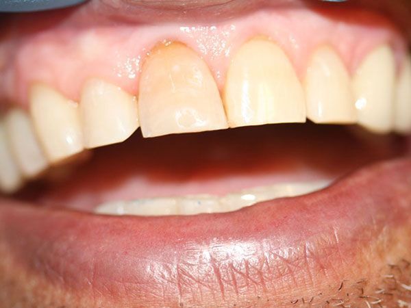 a close up of a man 's mouth with his teeth showing .