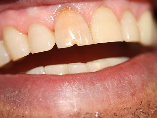 a close up of a person 's teeth with a broken tooth .