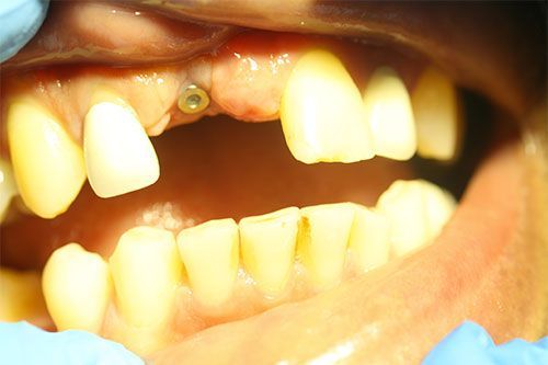a close up of a person 's mouth with a dental implant.