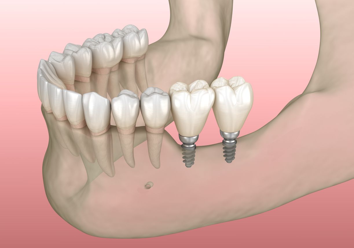 A computer generated image of a person 's teeth with dental implants.