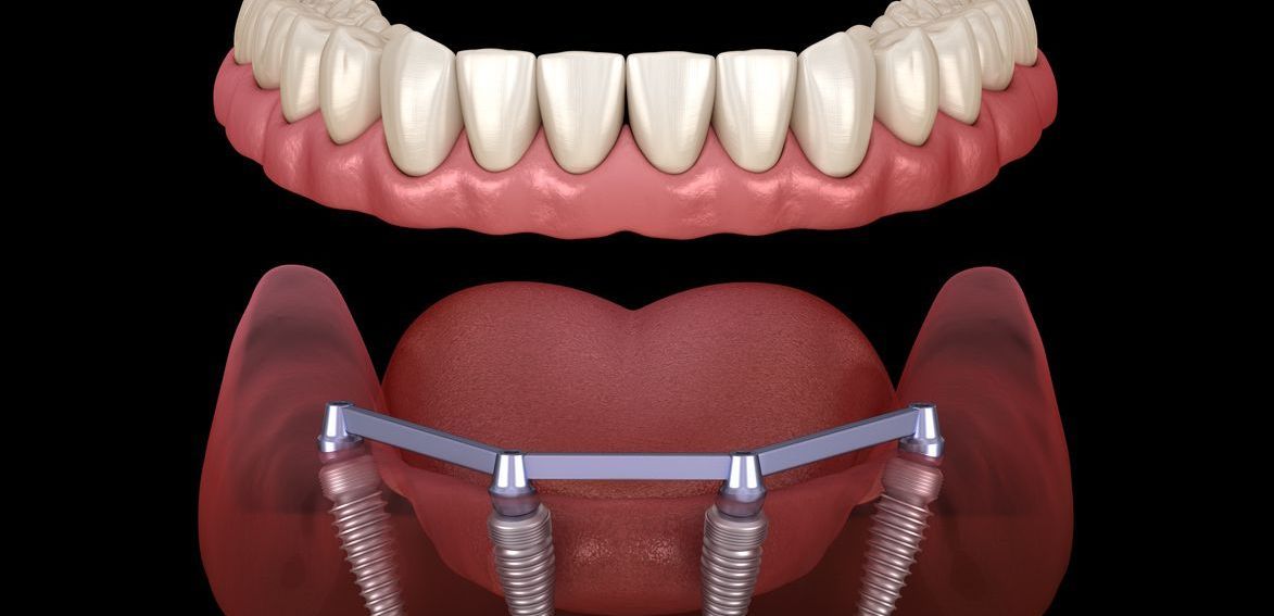 A computer generated image of a person 's teeth and a dental implant.