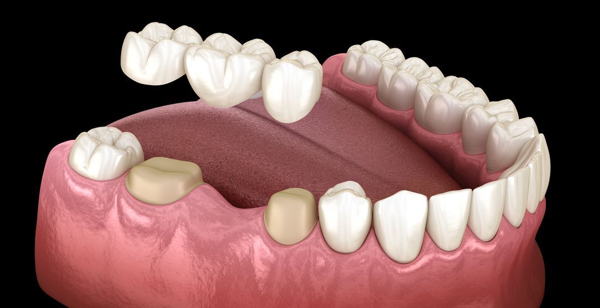 A computer generated image of a dental bridge in a mouth.