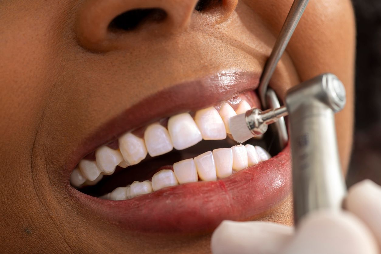 Dentist polishing teeth with a dental tool, close-up of mouth and teeth.