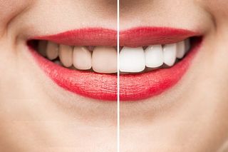 Teeth Before & After Whitening - Teeth Whitening in Worth, IL