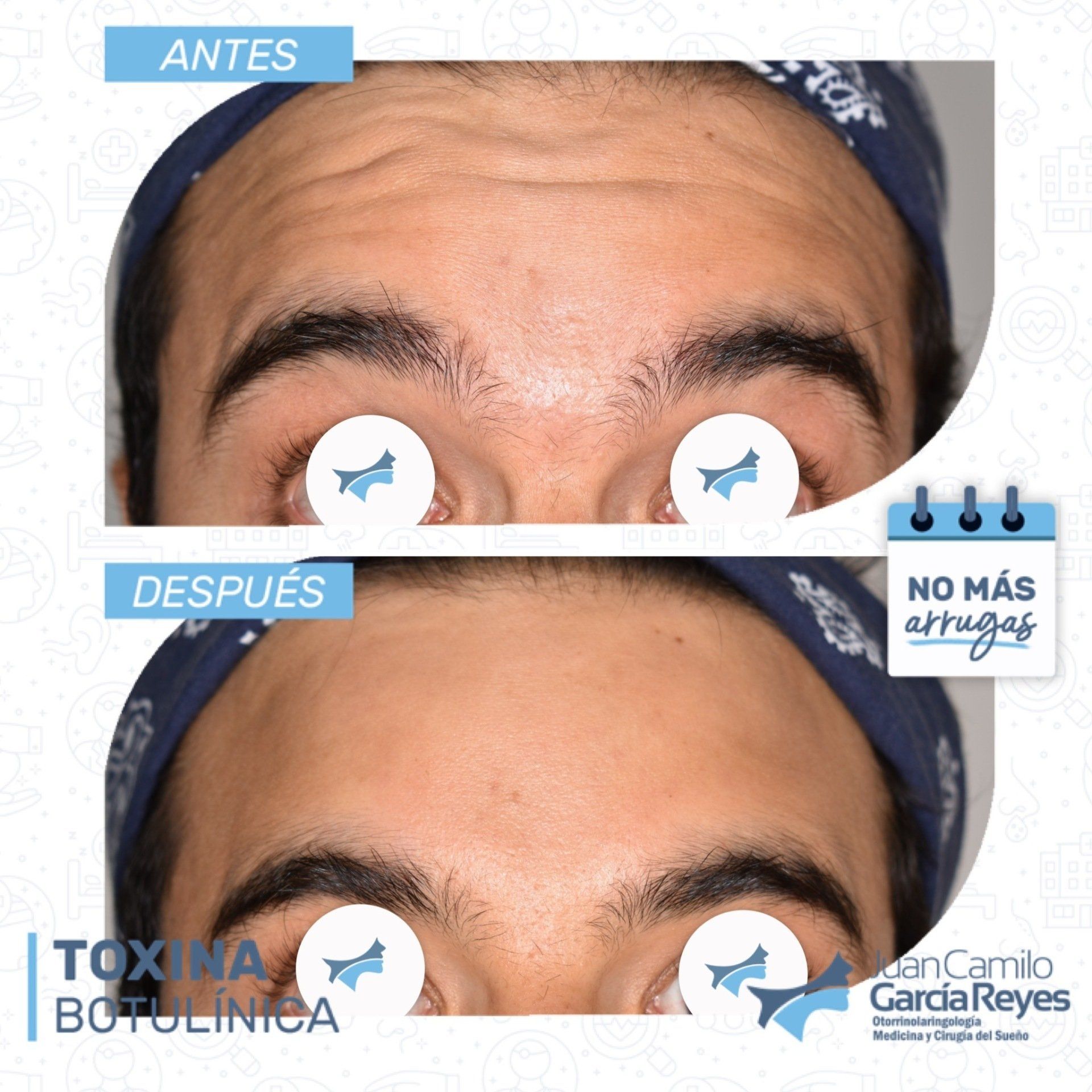 Arrugas de la frente antes y después del tratamiento con toxina botulínica.