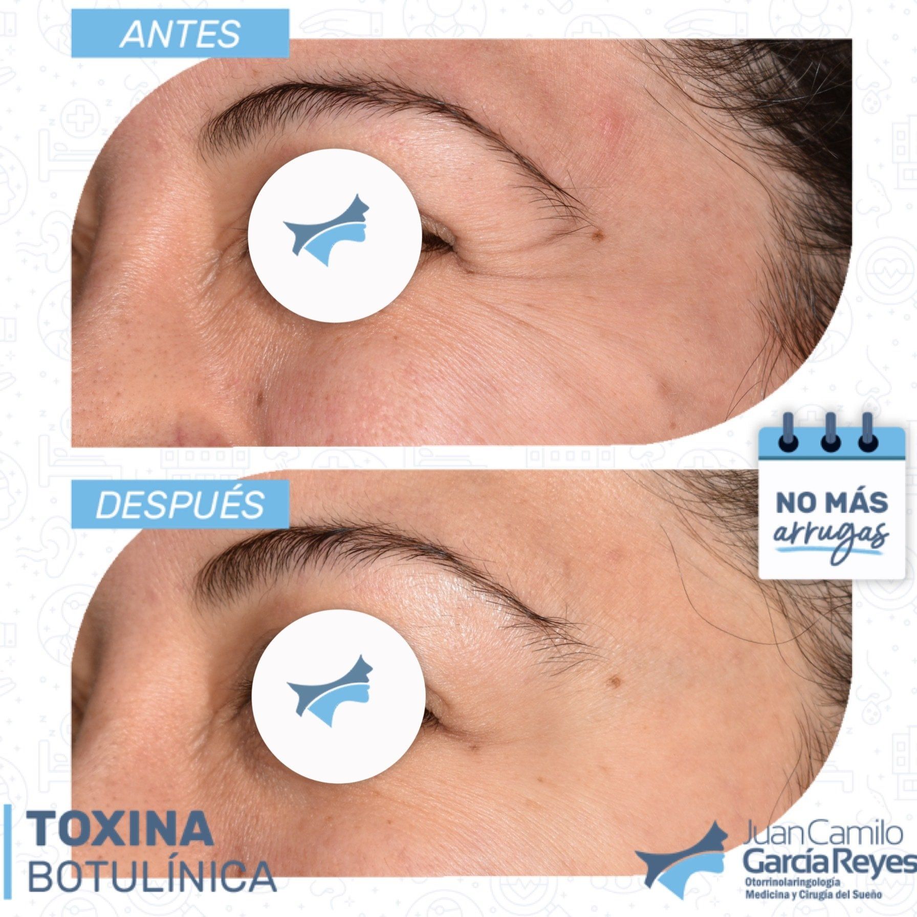 Fotografías de antes y después  tratamiento con toxina botulínica.