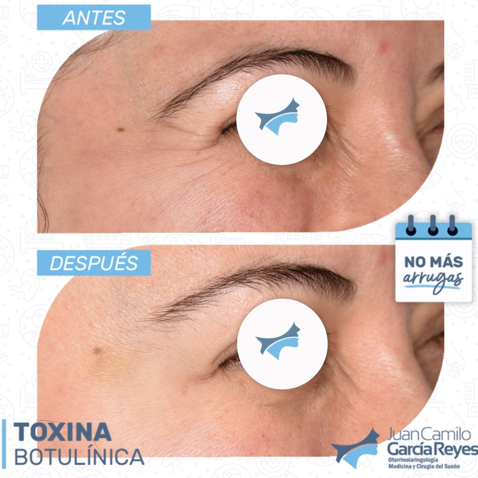 Comparación de ojos, antes y después del tratamiento con toxina botulínica para las arrugas.