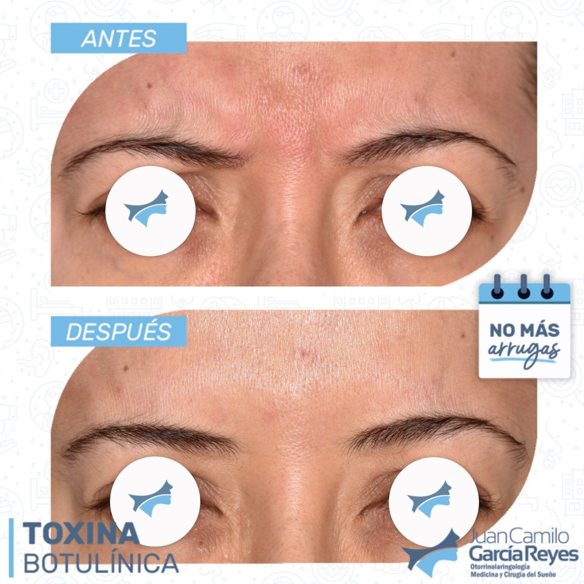 Las fotos del antes y el después muestran el tratamiento con toxina botulínica. La foto del después muestra menos arrugas.