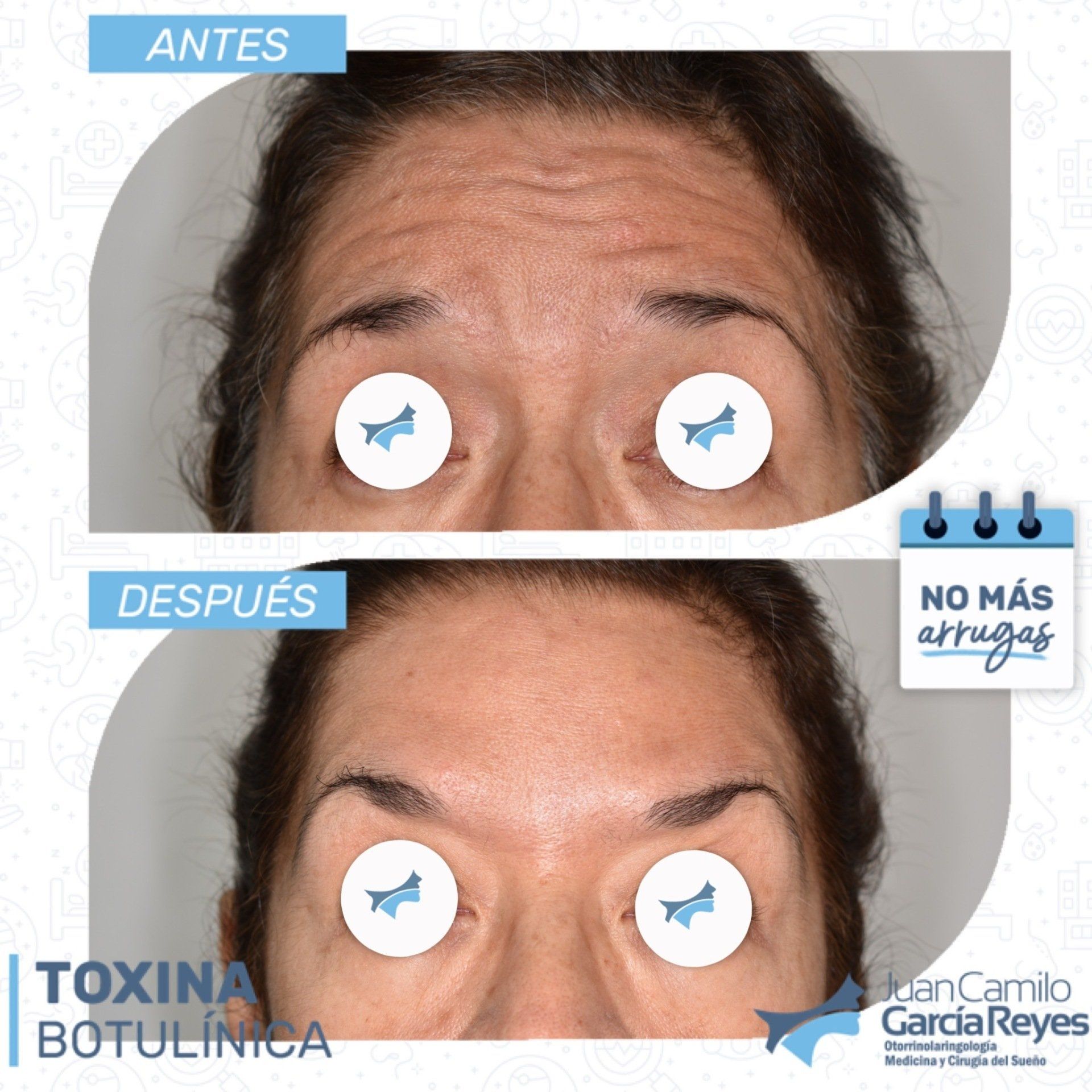 Fotografías de antes y después reducción de arrugas después del tratamiento con toxina botulínica.