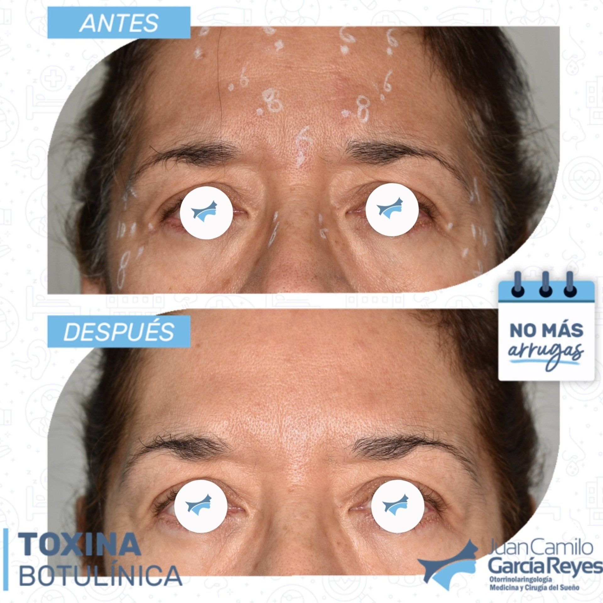 Comparación: Antes y después del tratamiento con Botox en la frente de una mujer, reduciendo las arrugas.