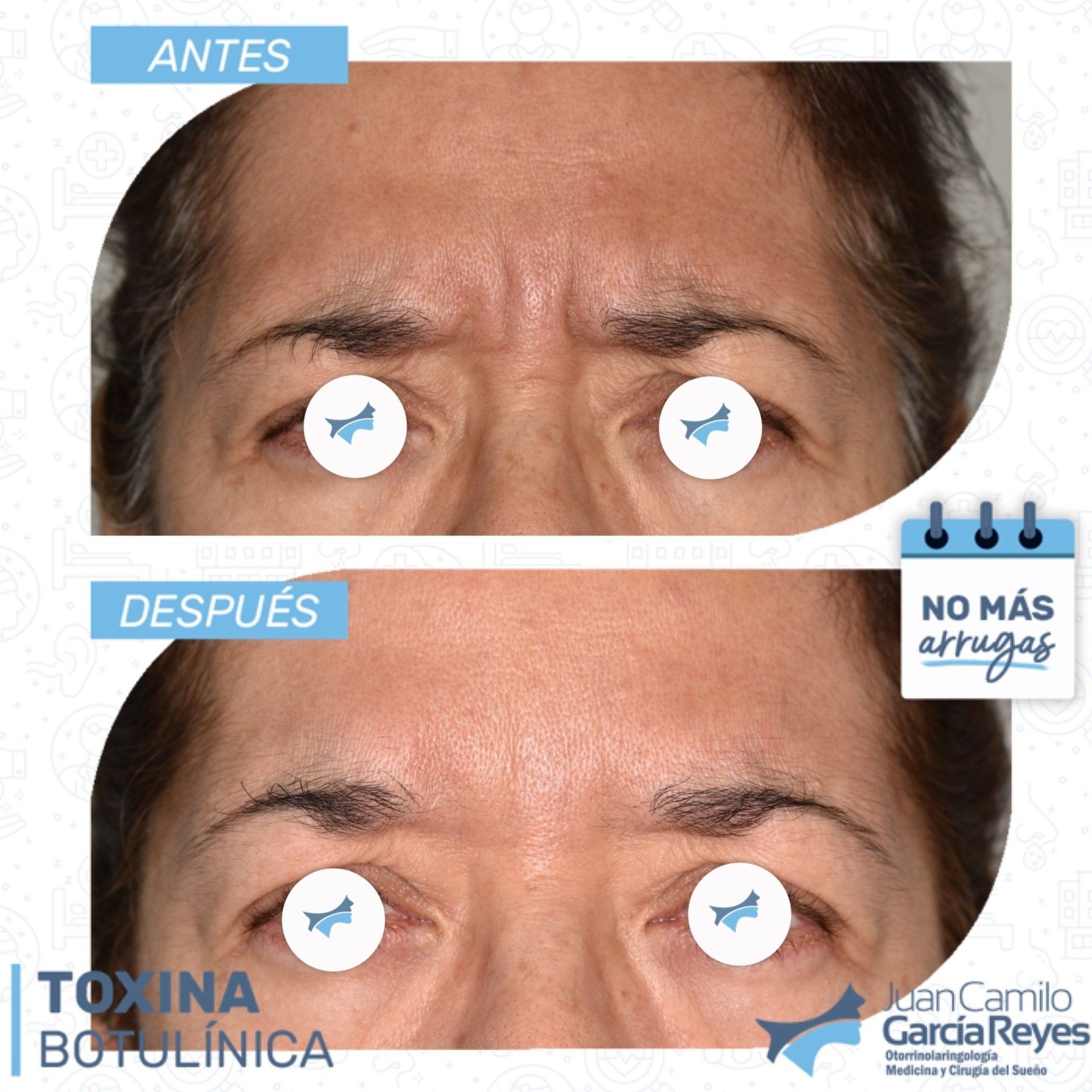 Comparación antes/después: las arrugas de la frente de la mujer se reducen después del tratamiento con toxina botulínica.