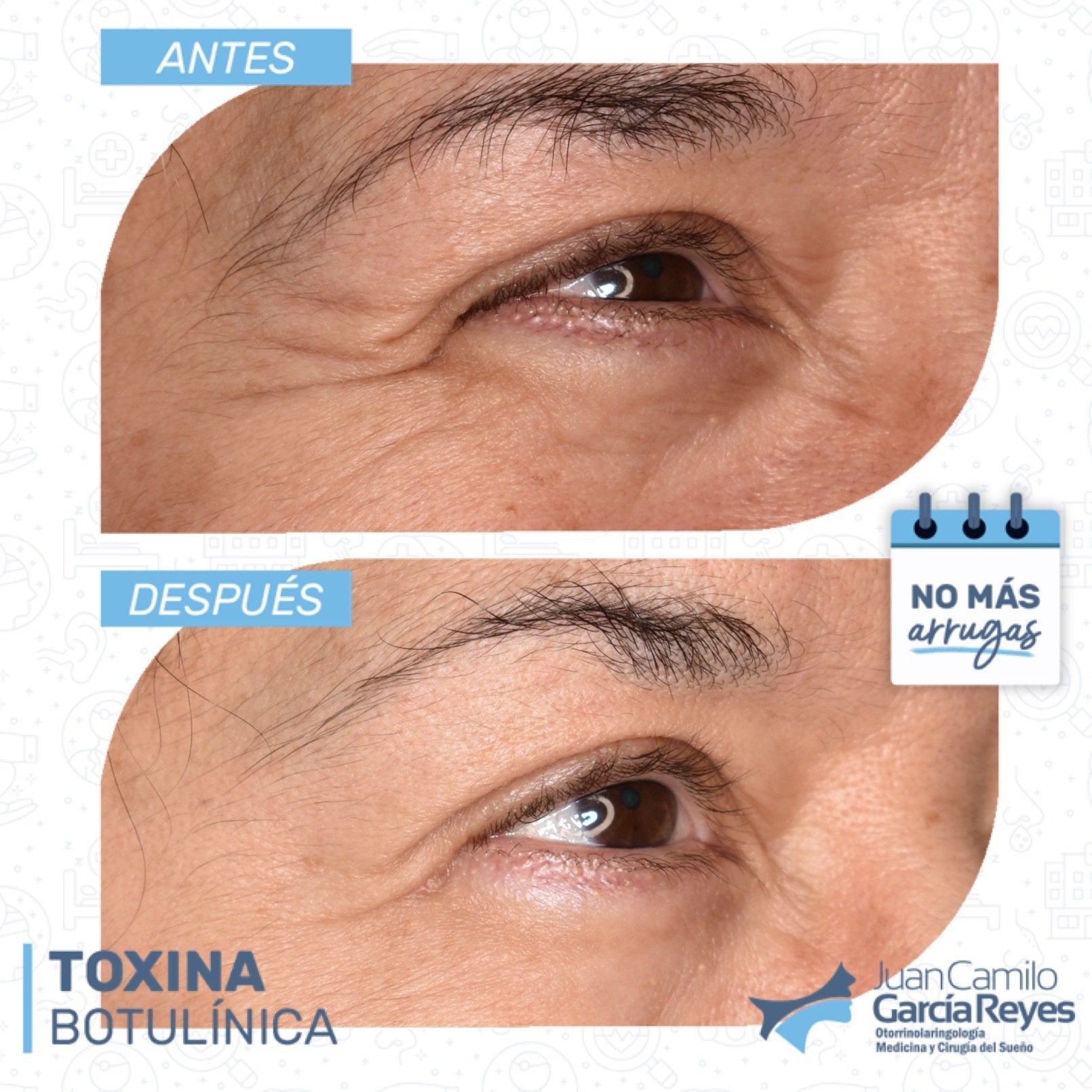 Comparación del tratamiento de arrugas de los ojos: utilizando toxina botulínica para reducir las arrugas.