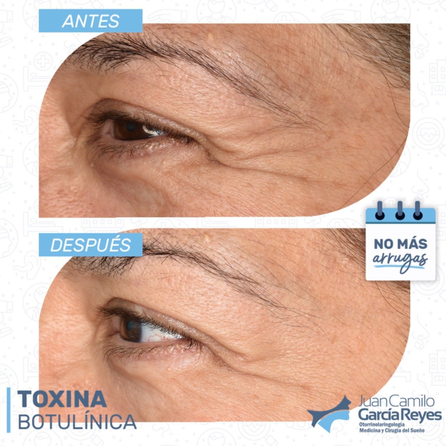 Tratamiento de arrugas antes/después: tratamiento con toxina botulínica.