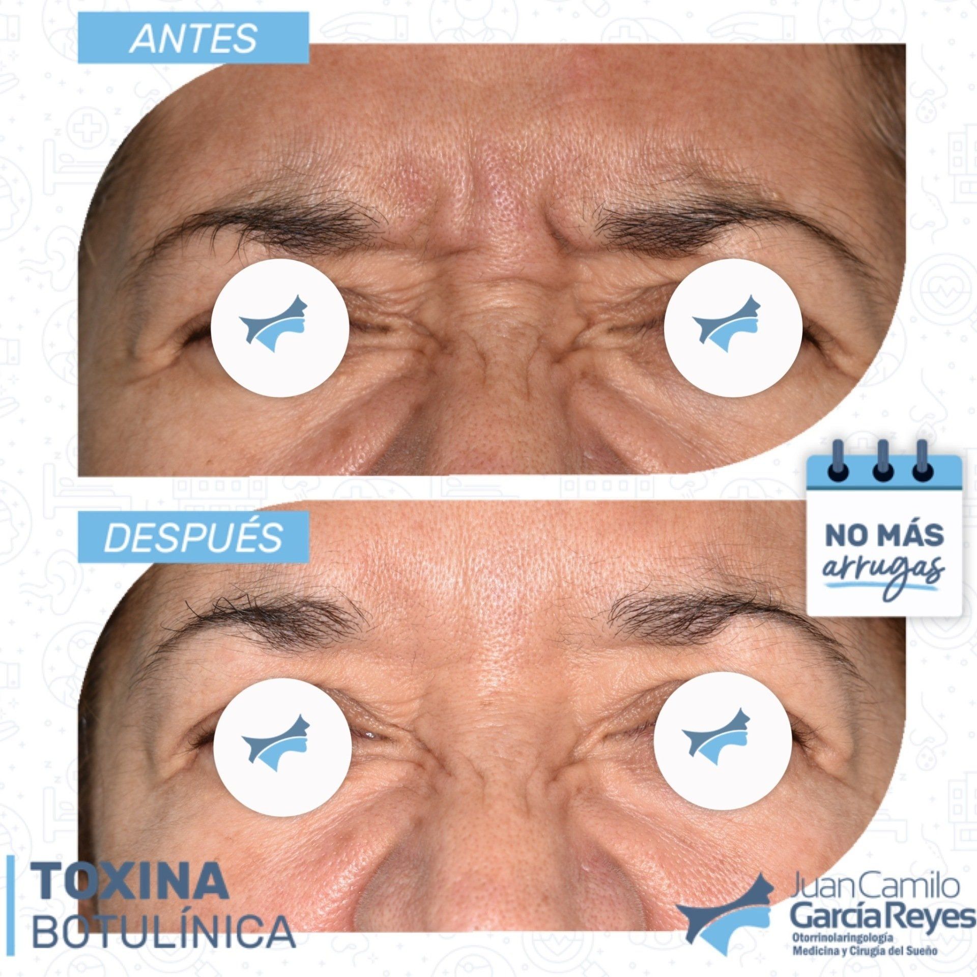 Comparación antes y después de las arrugas de la frente de una mujer tratadas con toxina botulínica.