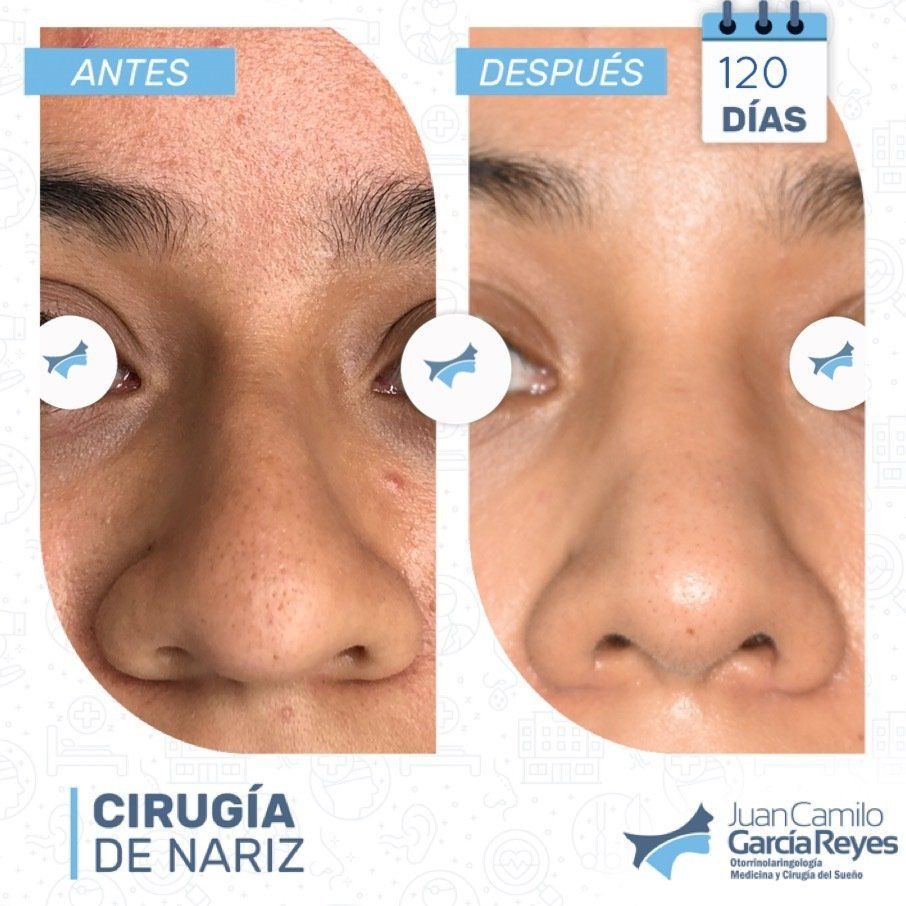 Comparación del antes y el después de la cirugía de nariz, 120 días después de la operación. 