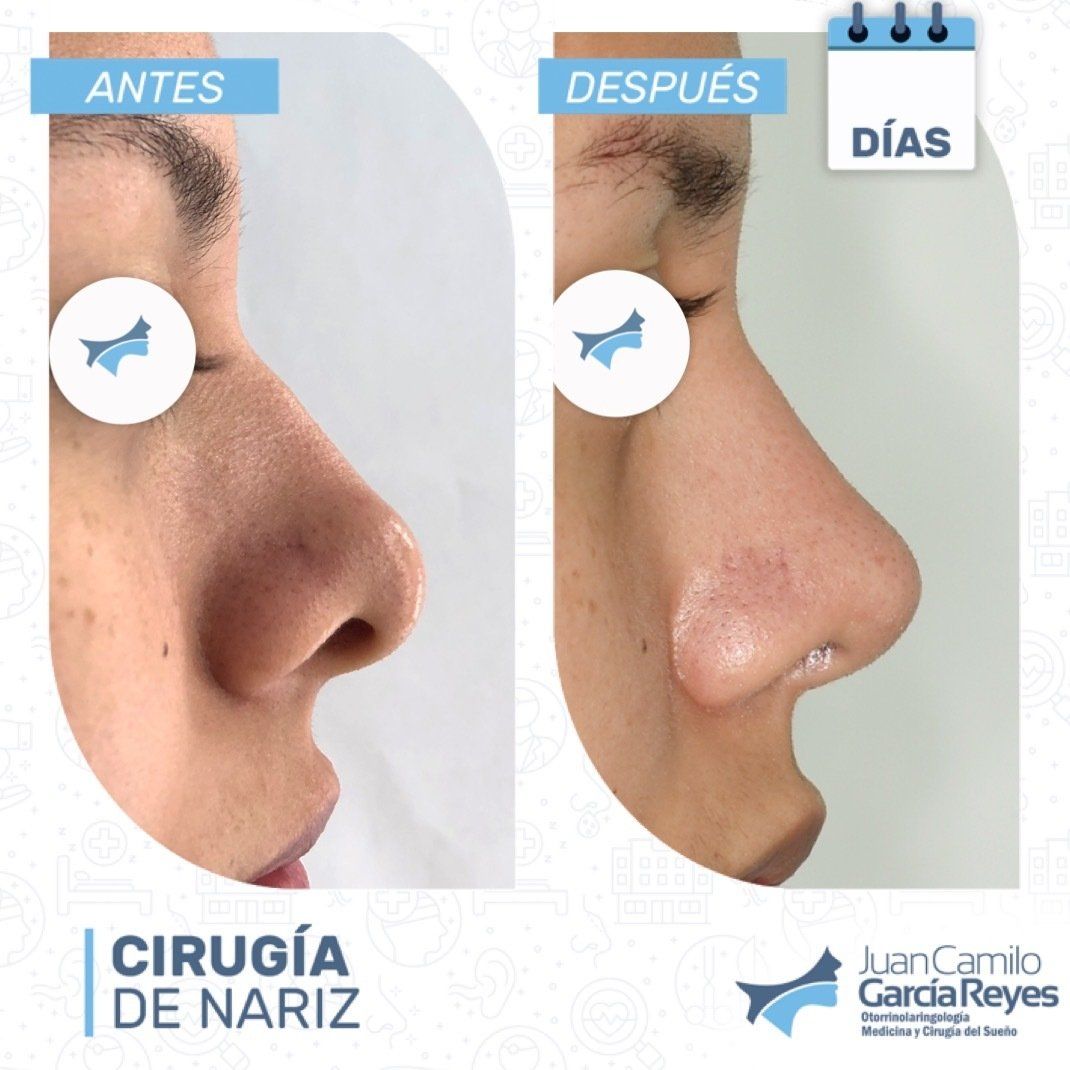 Comparación de una nariz antes y después de una rinoplastia.