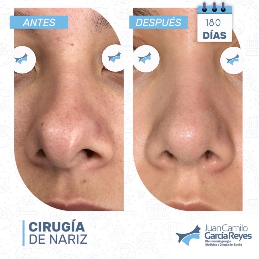 Comparación de una nariz antes y después de una rinoplastia; resultados después de 180 días.