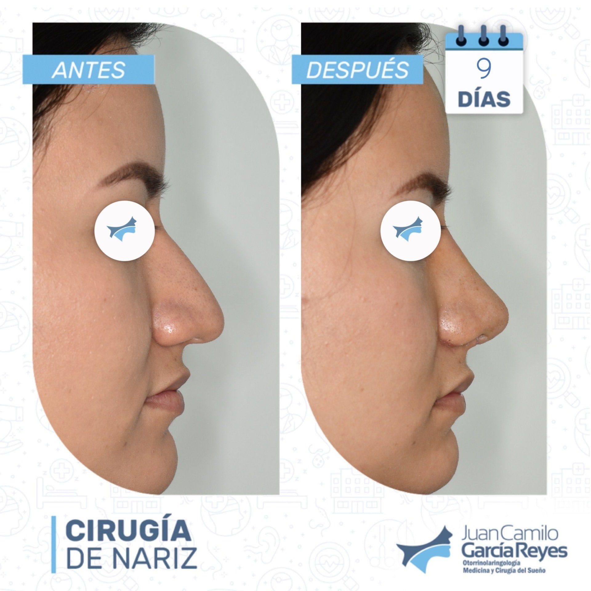 Comparación lado a lado de la nariz de una mujer antes y después de una rinoplastia con una diferencia de 9 días.