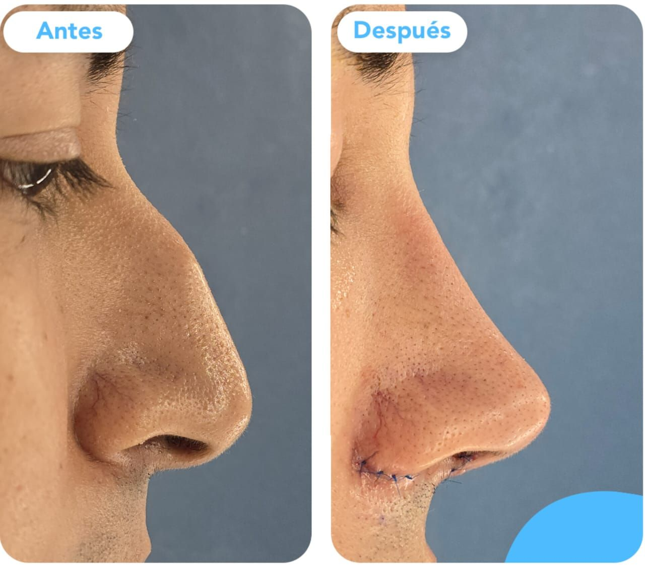 Rinoplastia sin tapones
