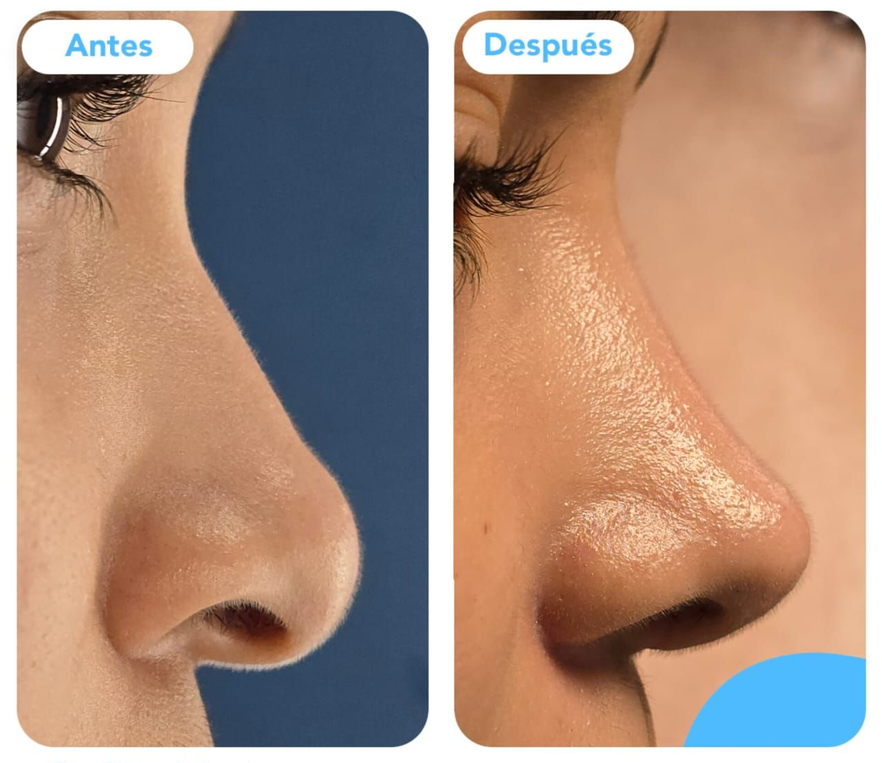 Rinoplastia sin tapones