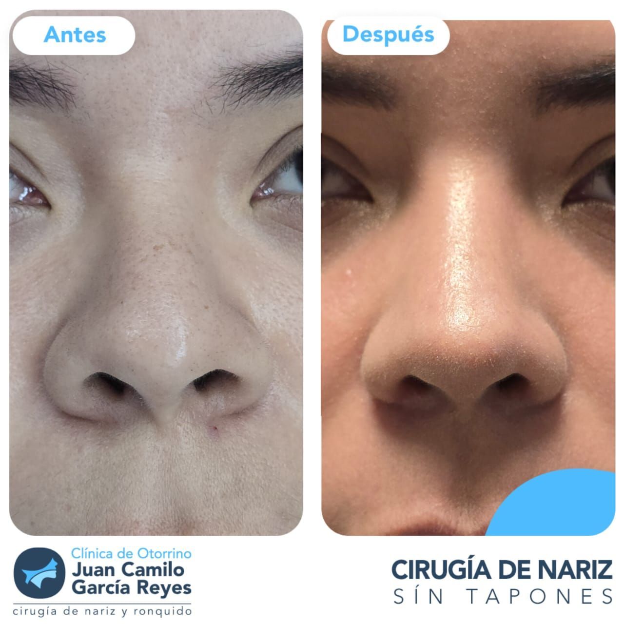 Antes y después de la rinoplastia; nariz de una persona con reducción visible de tamaño y forma refinada.