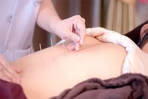 Acupuncture — Clearwater, FL — Pain Care Management