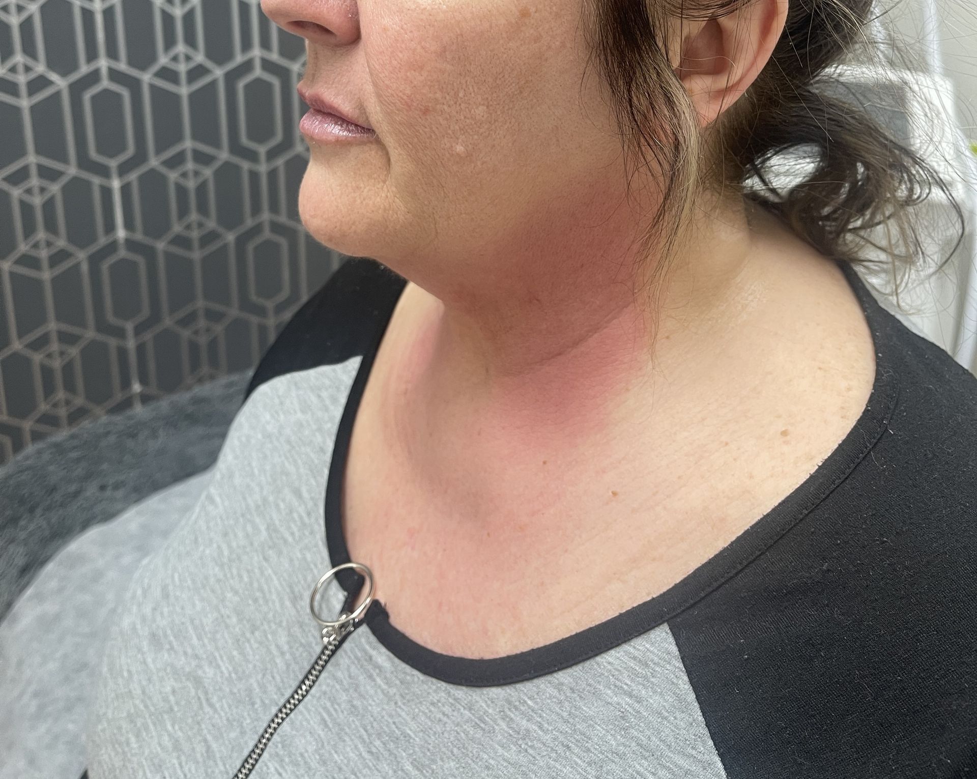 Venus Freeze Treatment 