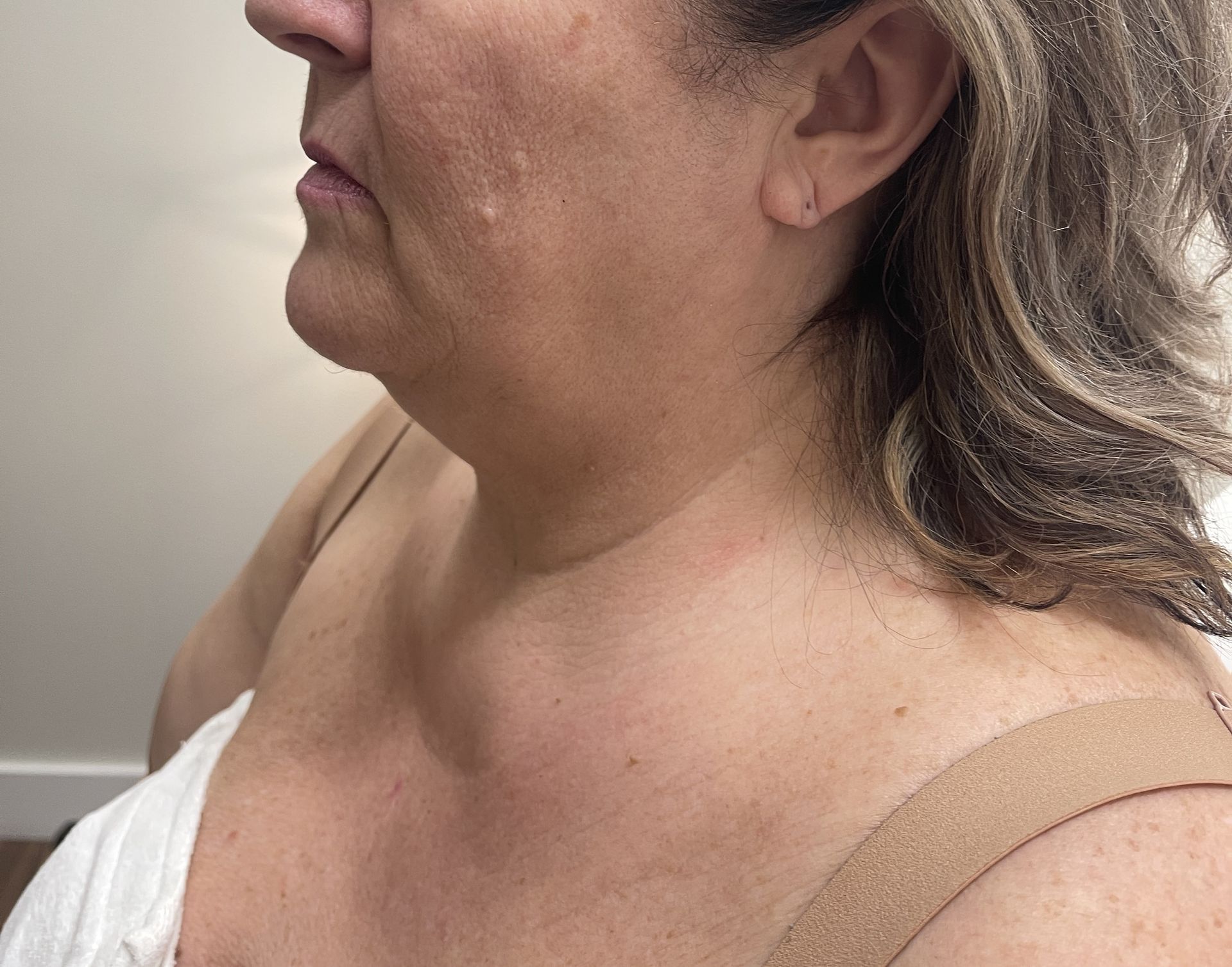 Venus Freeze Treatment 