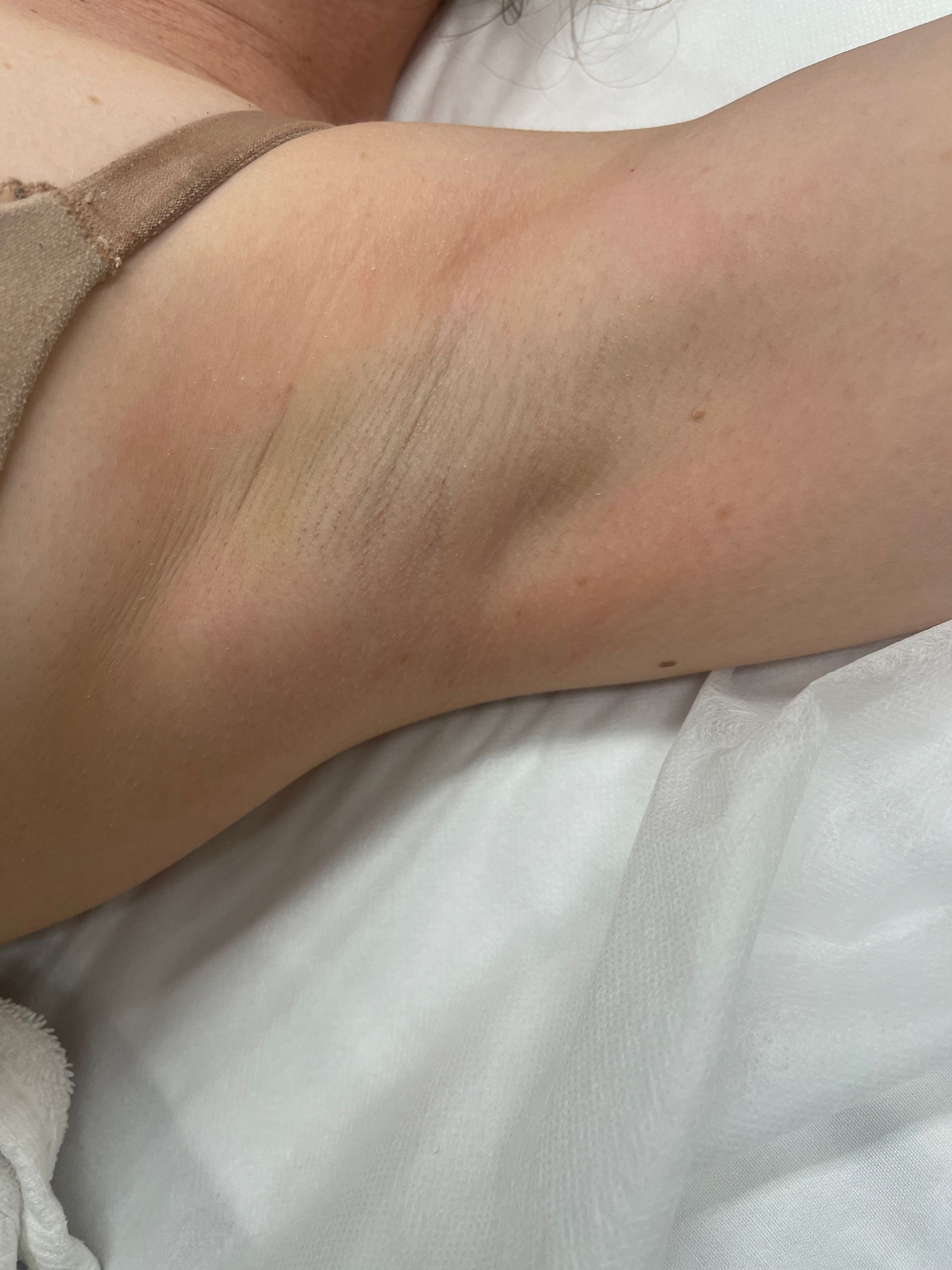 Laser body treatment