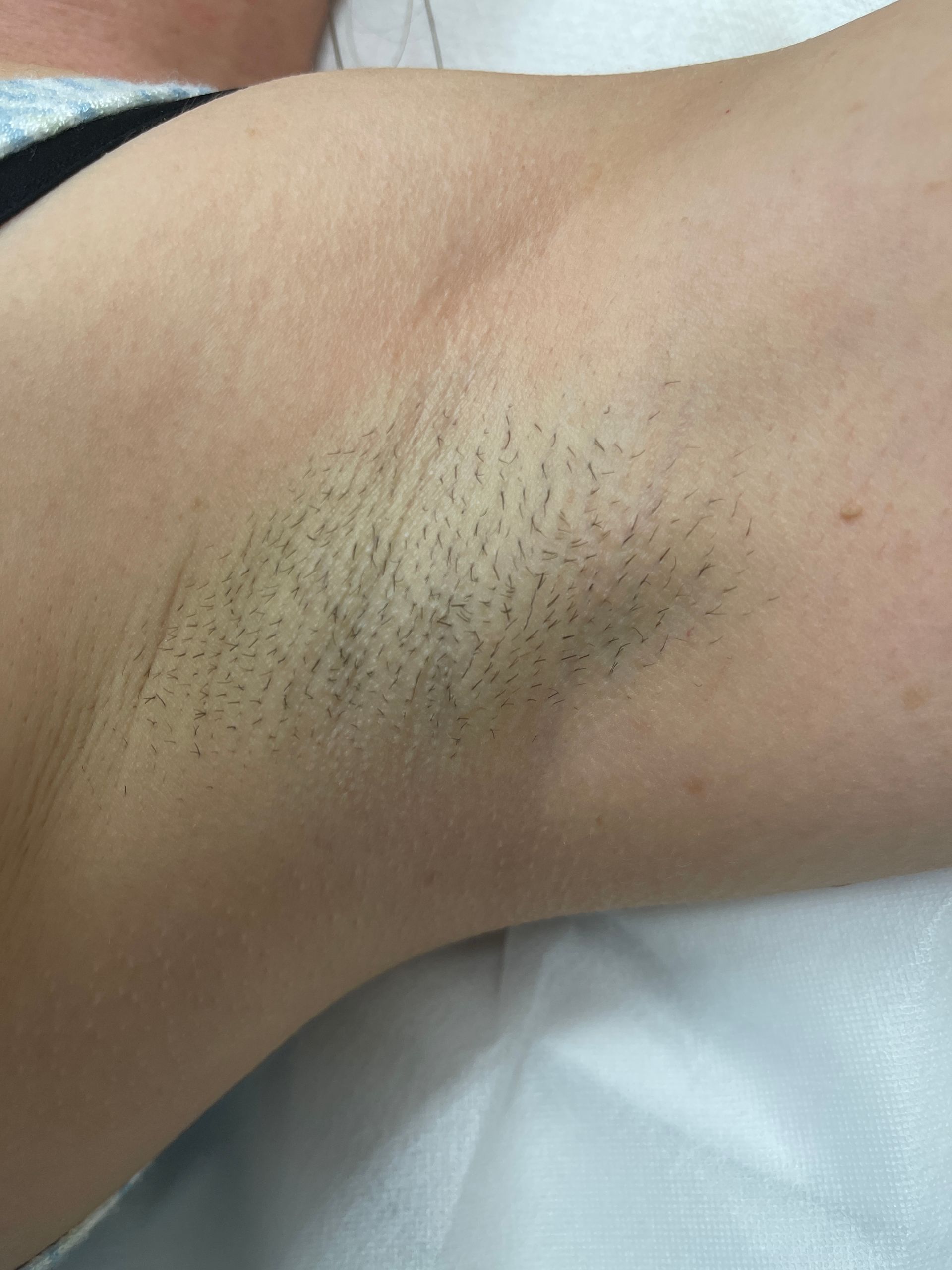 Laser body treatment