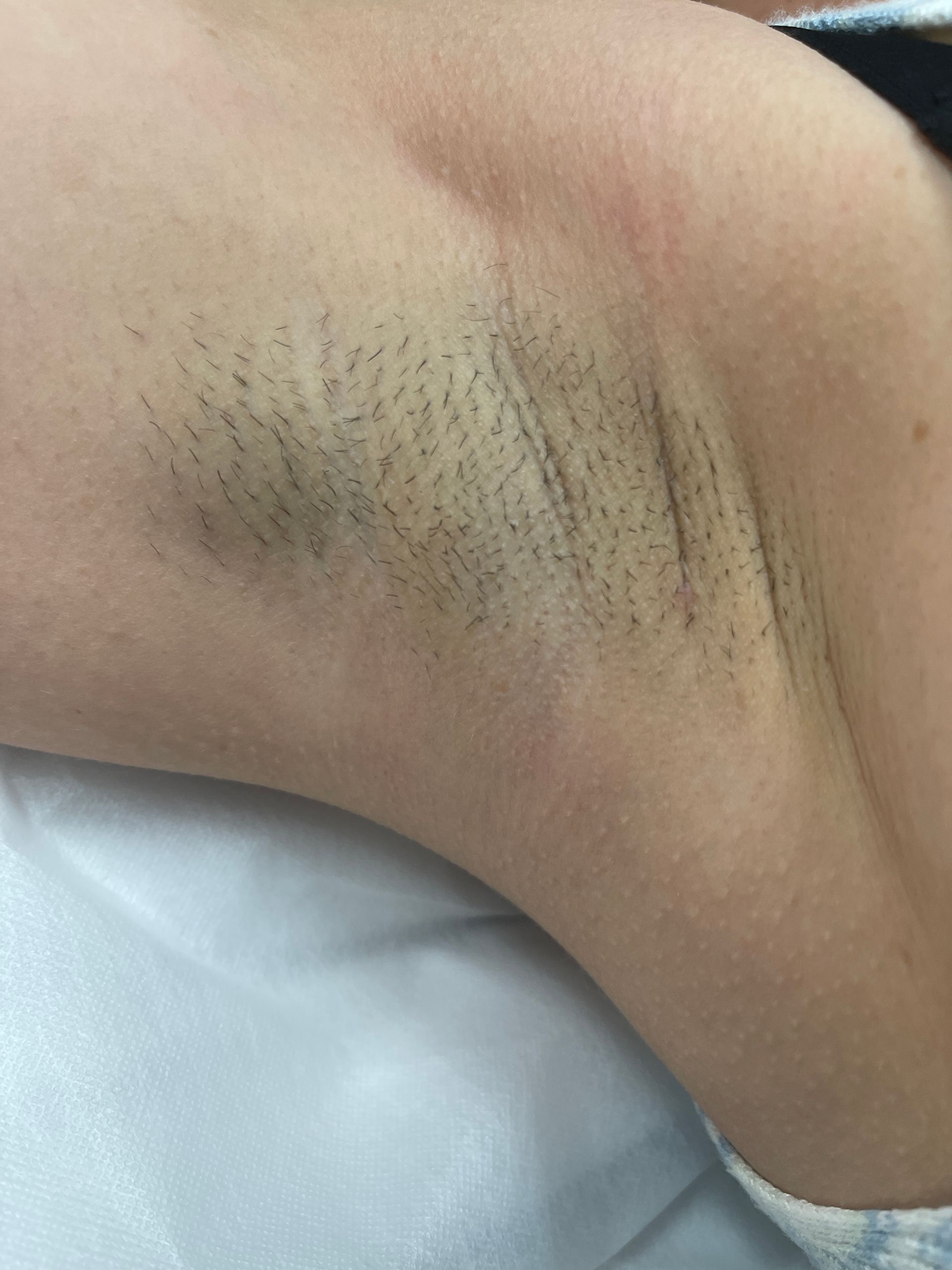 A close up of a person 's armpit with a lot of hair.