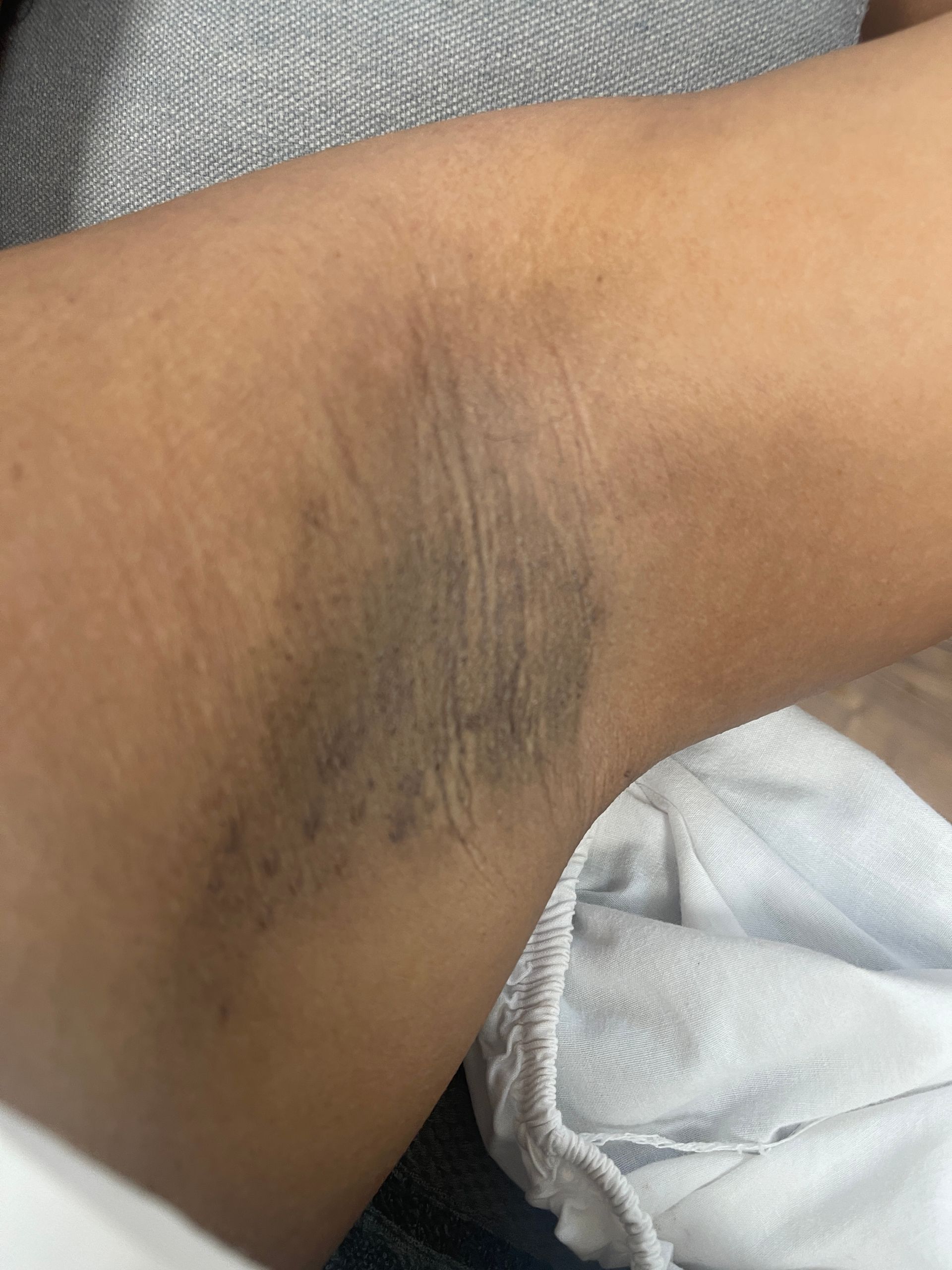 A close up of a person 's arm with a black spot on it.