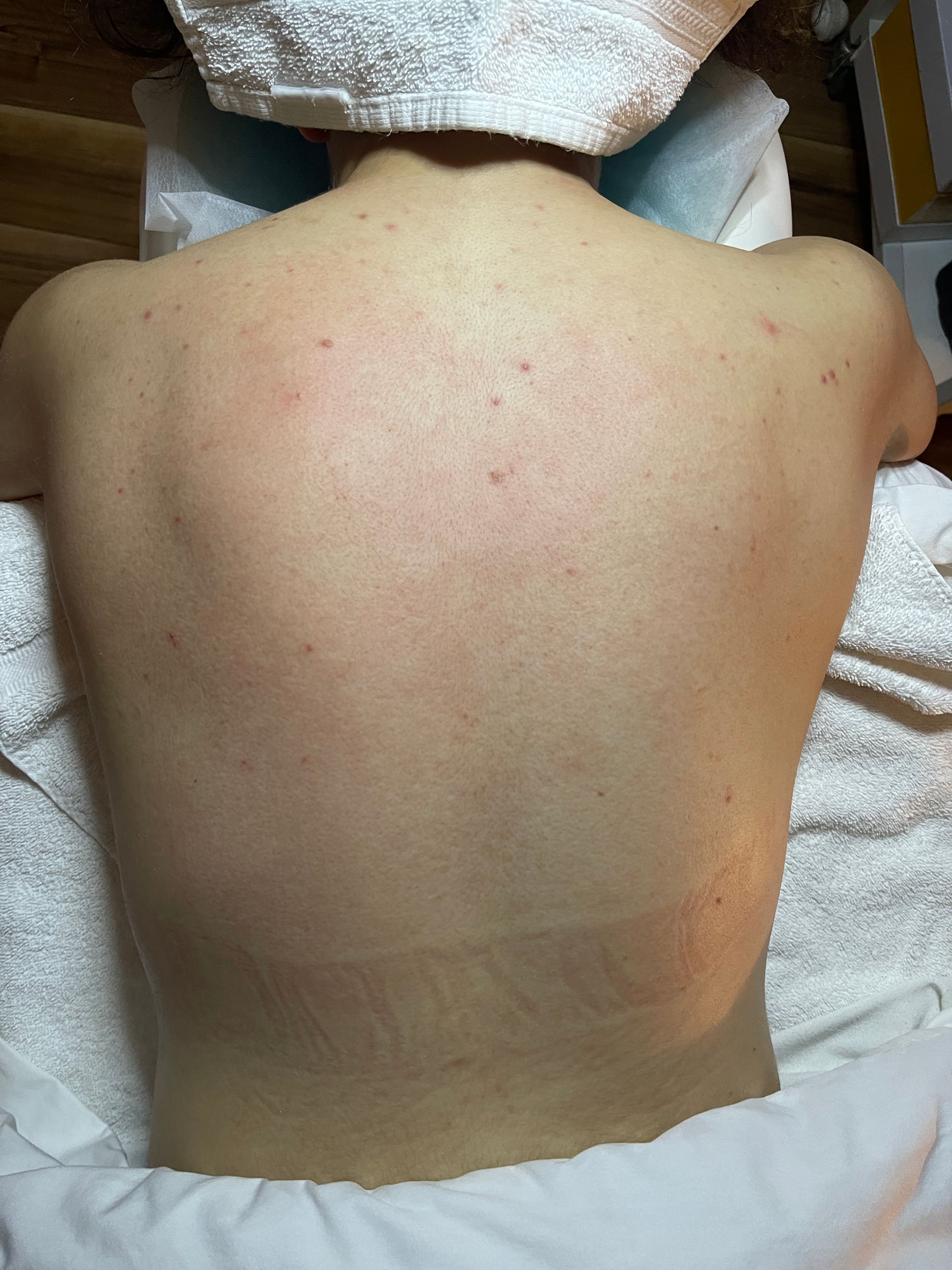 Before Back Facial Treatment 