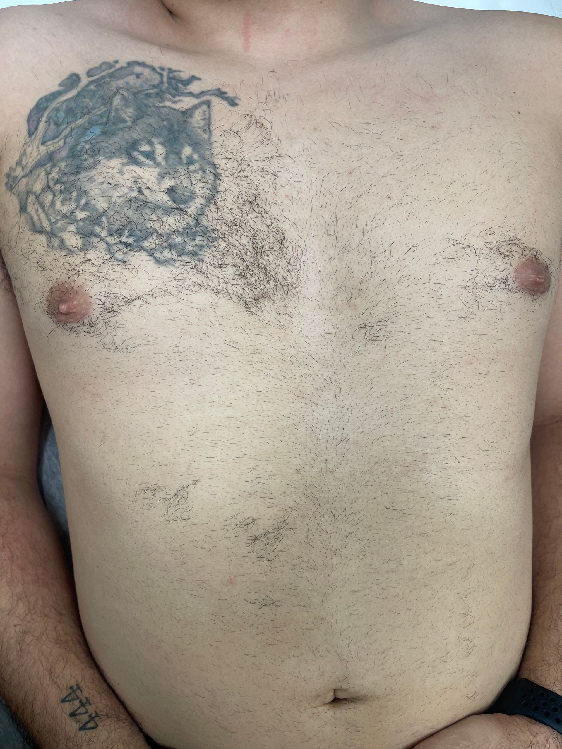 Laser body treatment