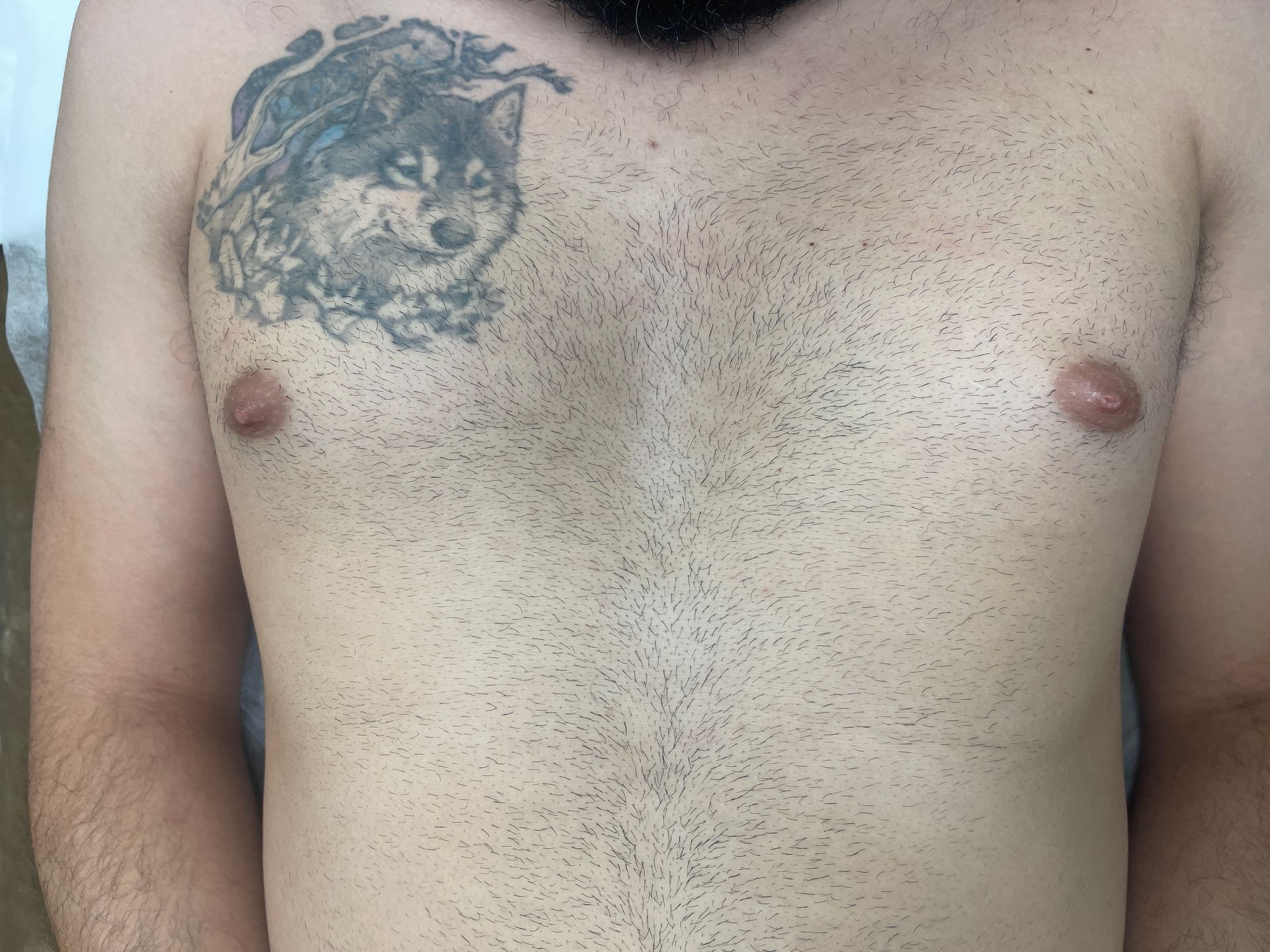 Laser body treatment