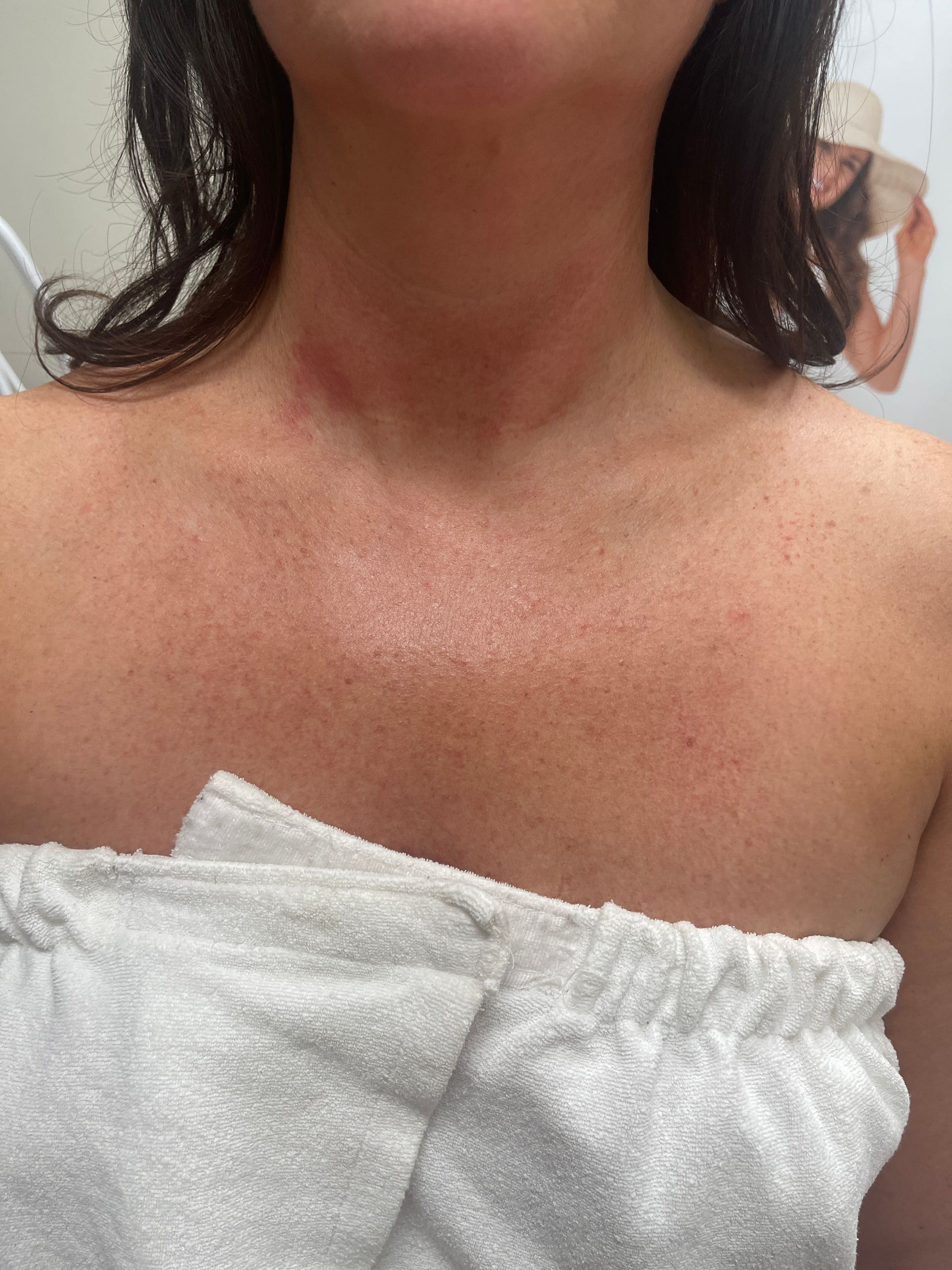 Venus Freeze Neck Treatment